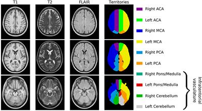 Spatial Signature of White Matter Hyperintensities in Stroke Patients